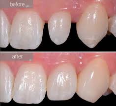 Dental Veneers