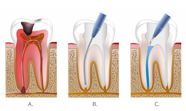 root canal